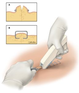 استپلر پوستی
