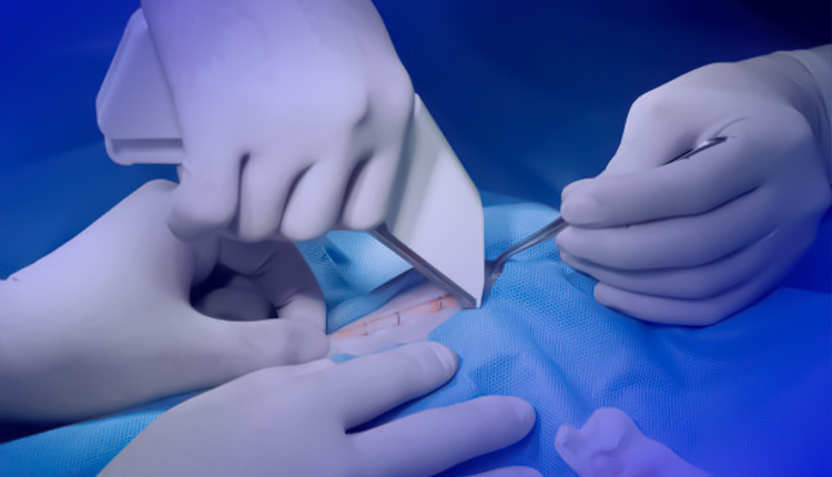 استپلر پوستی