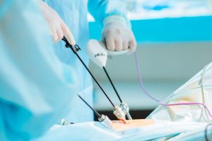 هموکلیپس لاپاروسکوپی