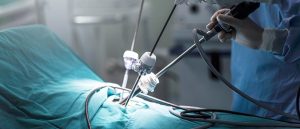 هموکلیپس لاپاروسکوپی