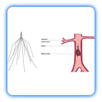 فیلتر IVC