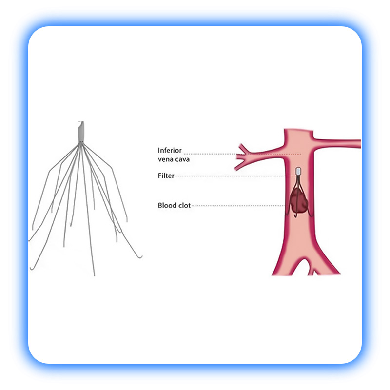 فیلتر IVC