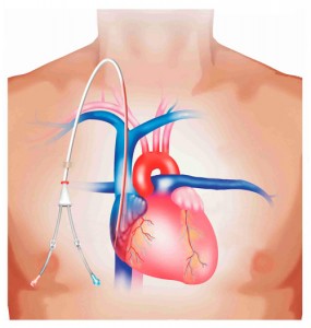 شالدون پرمیکت دیالیز
