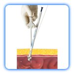 فاشیا کلوژر