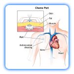 پورت شیمی درمانی