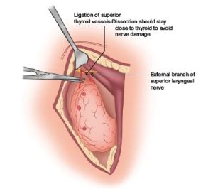 لیگاشور تیروئید