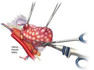 لیگاشور تیروئید