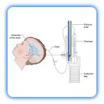 درن EVD - Image 3
