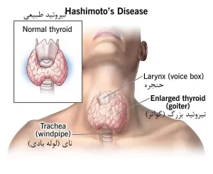لیگاشور تیروئید