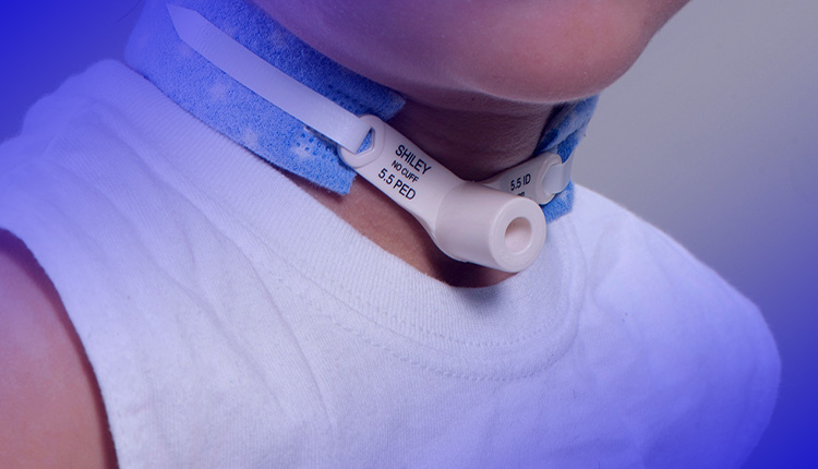 ست تراکستومی