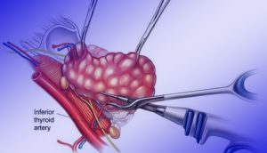 لیگاشور تیروئید