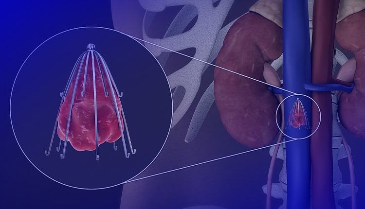 فیلتر ivc قلبی